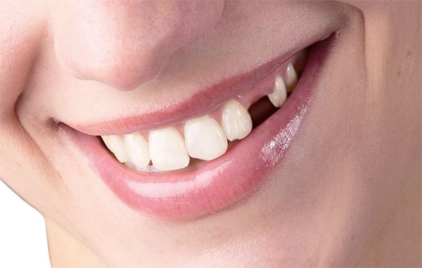 Nhổ răng số 4 có ảnh hưởng gì không?