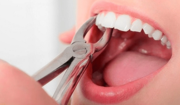 Nhổ răng số 5 hàm trên và dưới có nguy hiểm không?
