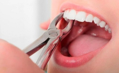 Nhổ răng vĩnh viễn có ảnh hưởng gì đến thần kinh không?