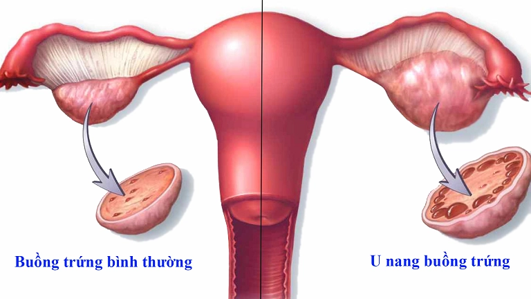 Những cách điều trị u nang buồng trứng