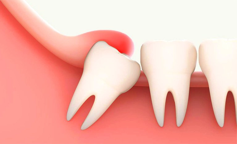 Những điều bạn nên biết về răng khôn