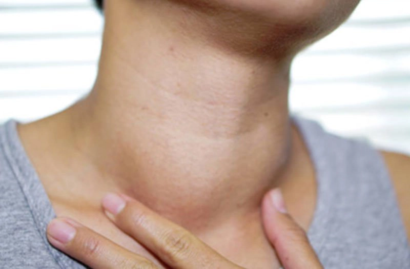 Những lưu ý sau khi mổ bướu cổ