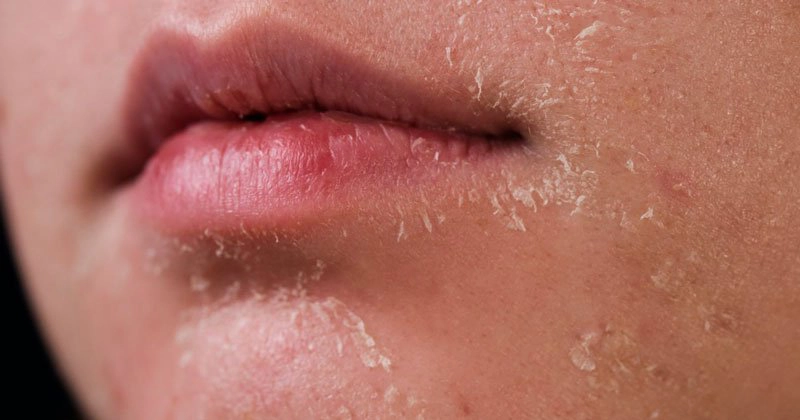 Những nguy cơ mắc bệnh về da mùa đông