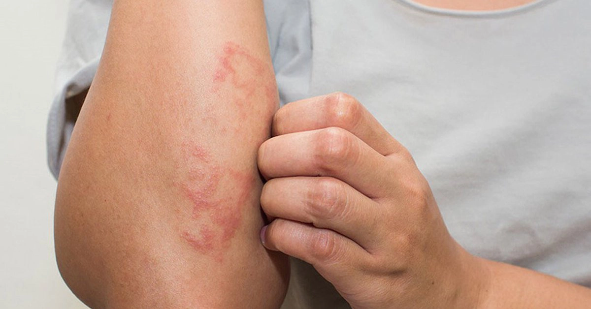 Những tác nhân gây bệnh chàm hàng đầu cần tránh