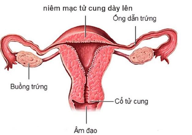 Nội mạc tử cung dày là sao, báo hiệu điều gì?