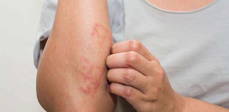 Nổi mày đay hậu COVID-19