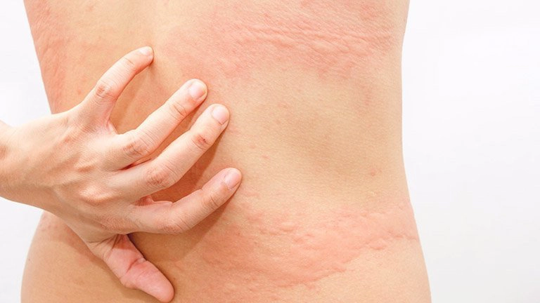 Nổi mề đay kéo dài không đỡ điều trị thế nào?
