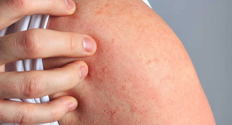 Nổi mề đay sau sinh có thuốc trị dứt điểm không?