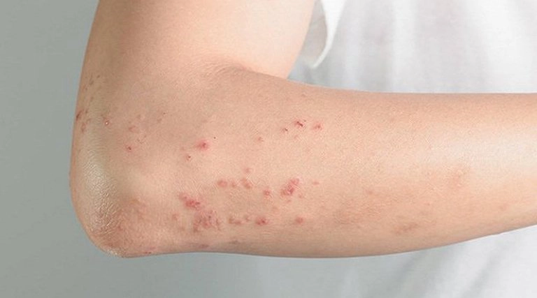 Nổi nốt đỏ kèm ngứa là dấu hiệu bệnh gì?