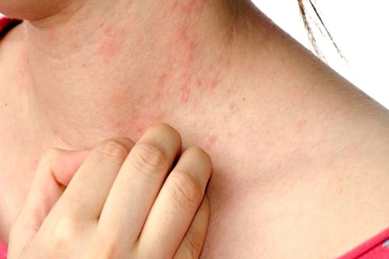Nổi nốt đỏ ngứa có bọng nước là bệnh gì?