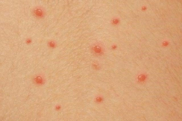 Nốt thủy đậu chuyển sang màu trắng đục có phải bị nhiễm trùng?
