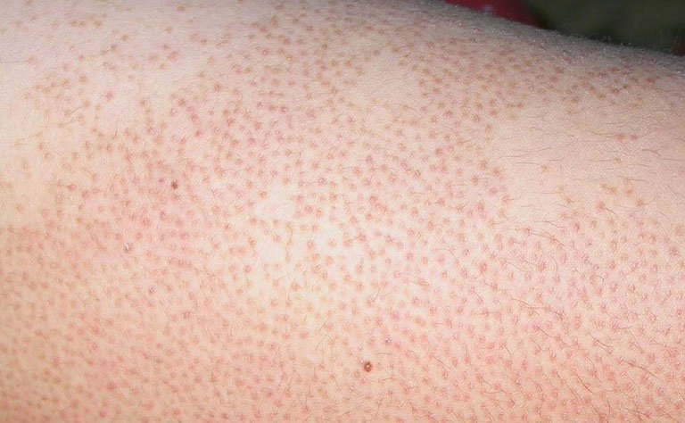 Nữ giới viêm lỗ chân lông điều trị như thế nào?
