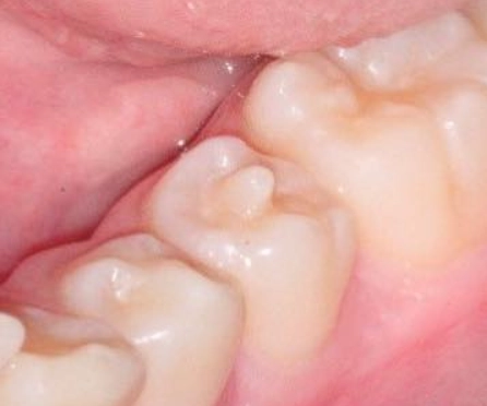 Núm phụ: Bất thường răng cần chú ý