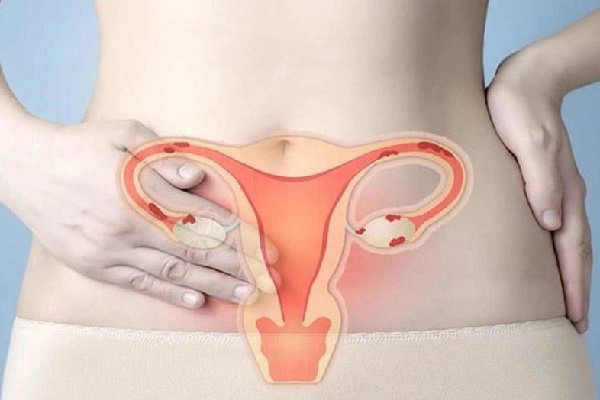 Pap smear, sinh thiết, CT, MRI trong chẩn đoán ung thư cổ tử cung