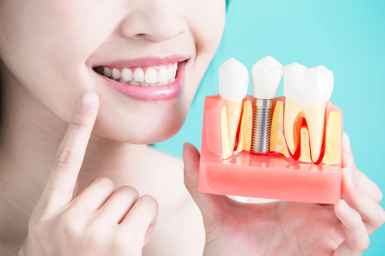 Phải làm sao để lấp khoảng trống do mất 2 răng số 6 hàm dưới?