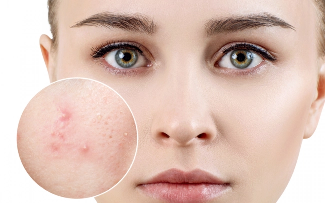 Phân biệt các loại mụn
