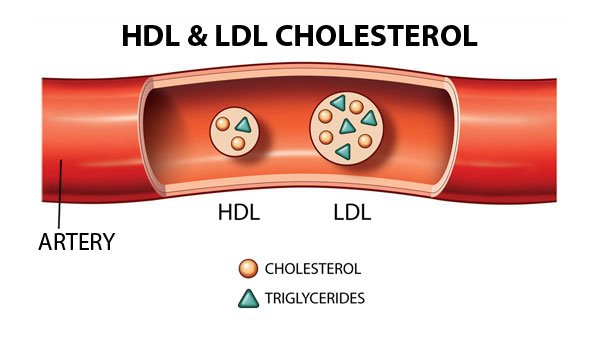 Phân biệt giữa LDL cholesterol và HDL cholesterol