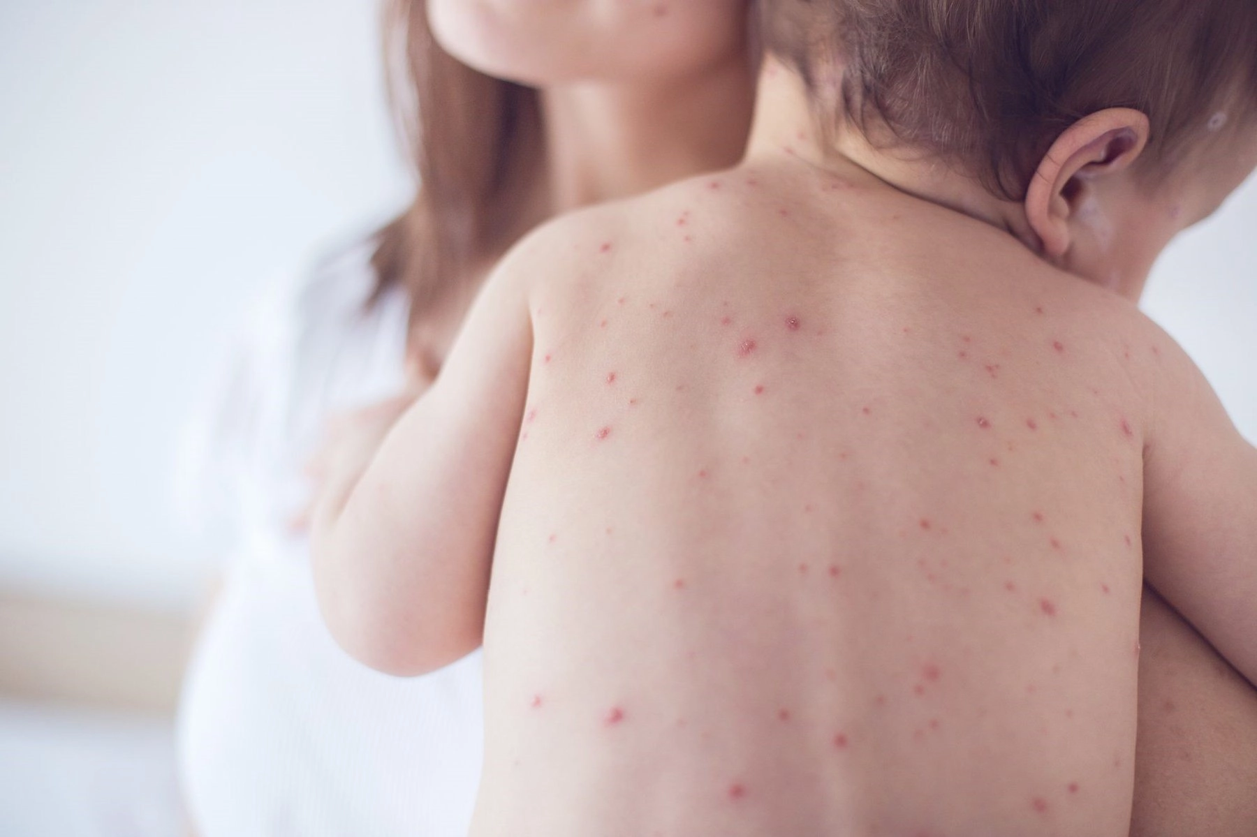 Phân biệt hình ảnh bệnh sốt xuất huyết ở trẻ em