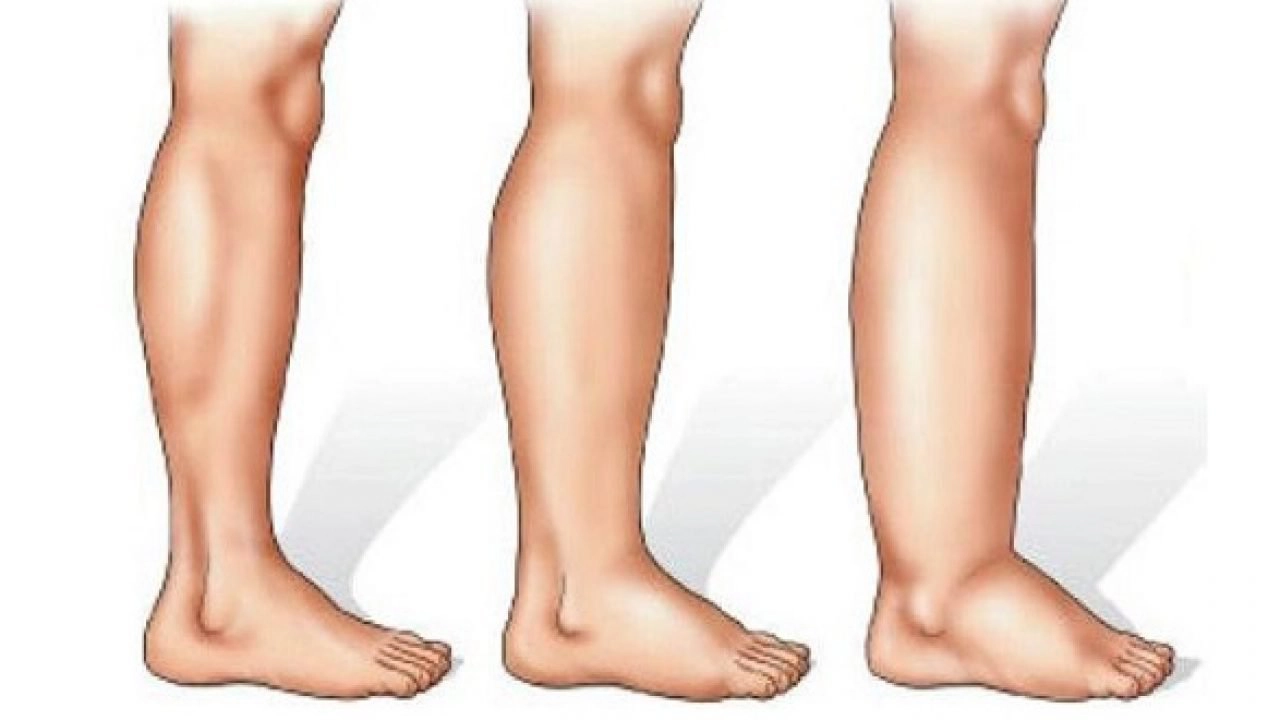 Phân loại chẩn đoán và điều trị mày đay phù mạch