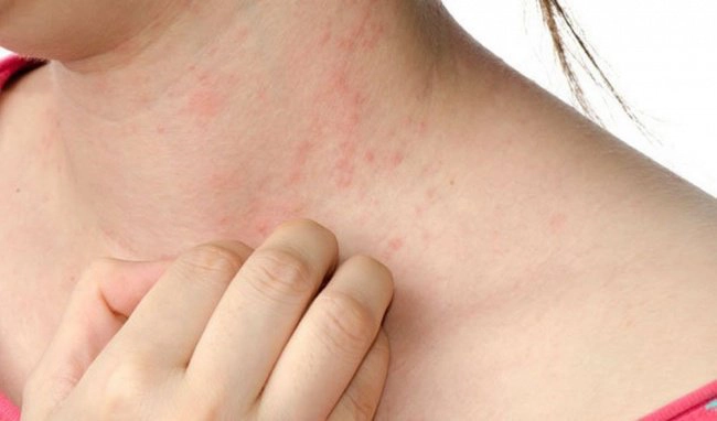 Phát ban ngứa khắp người khi mắc sốt xuất huyết có sao không?