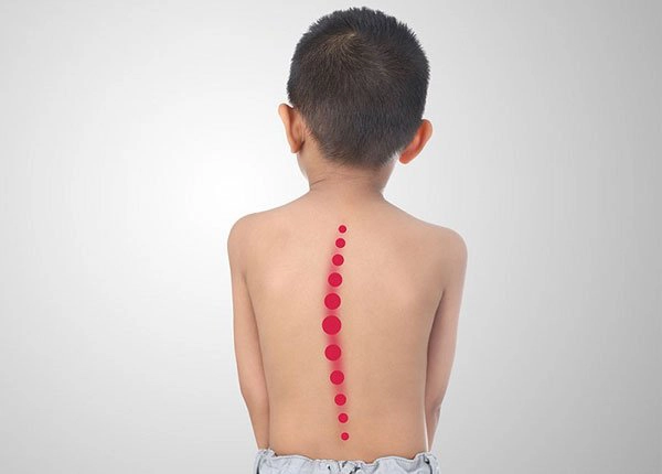 Phẫu thuật chỉnh vẹo cột sống ở trẻ