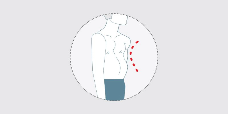 Phẫu thuật điều trị lõm ngực bẩm sinh