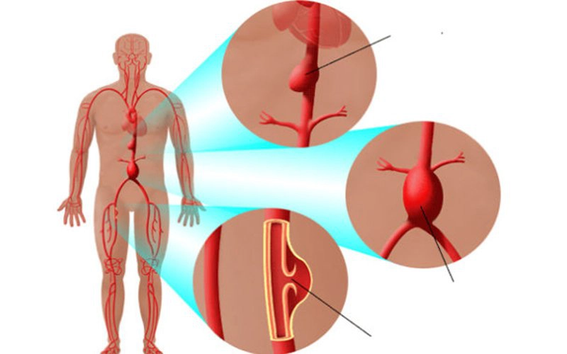 Phẫu thuật điều trị phình động mạch chủ bụng dưới thận