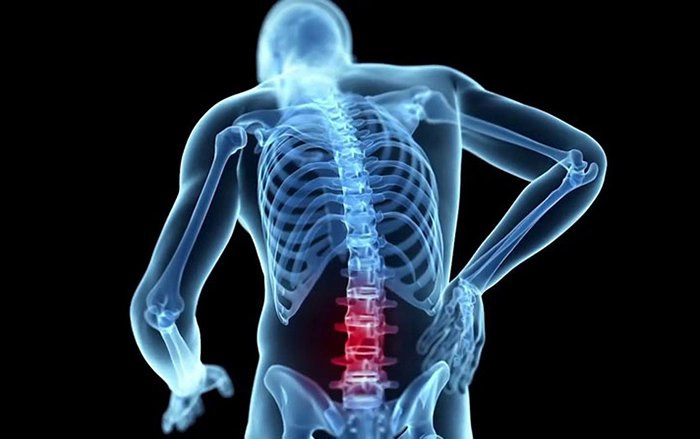 Phẫu thuật giải ép tủy trong lao cột sống lưng