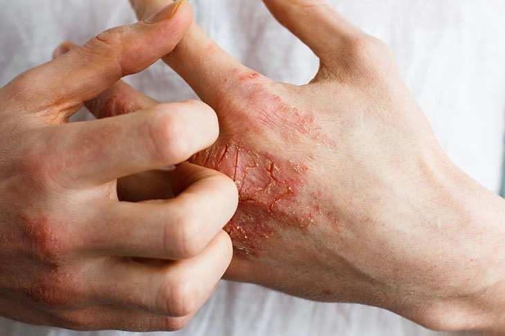 Phòng bệnh do viêm da tụ cầu