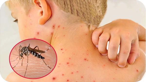 Phòng ngừa biến chứng sốt xuất huyết cho trẻ