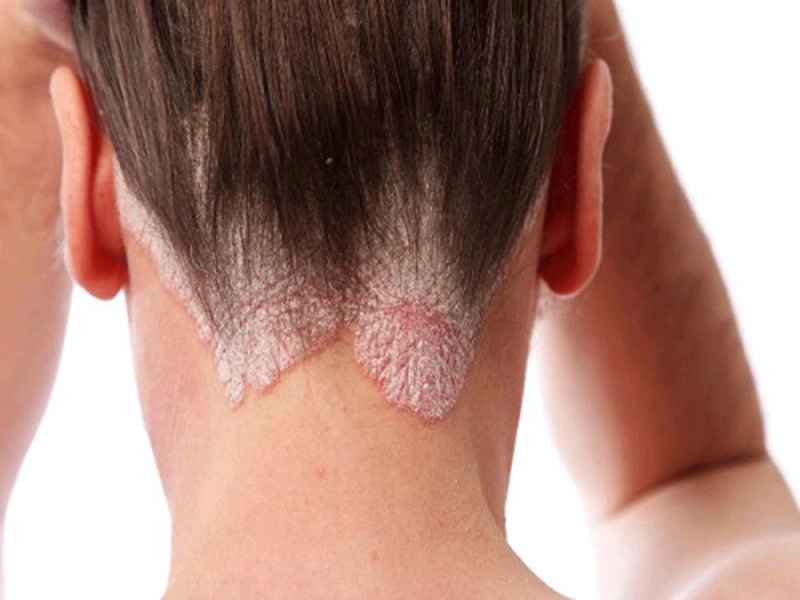 Phương pháp điều trị nấm da đầu như thế nào?