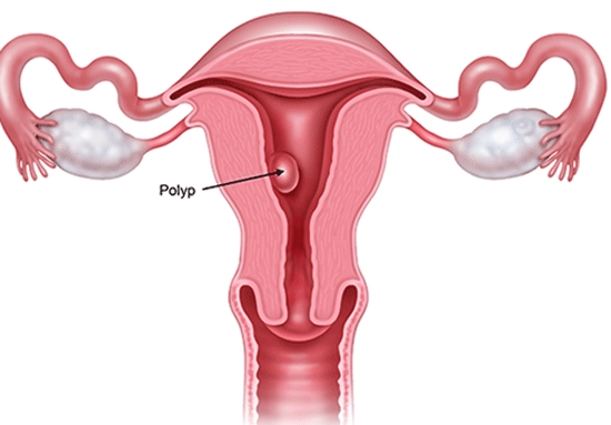 Polyp lòng tử cung có nguy hiểm không?