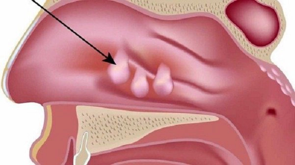Polyp mũi độ 3 một bên có nguy hiểm không?