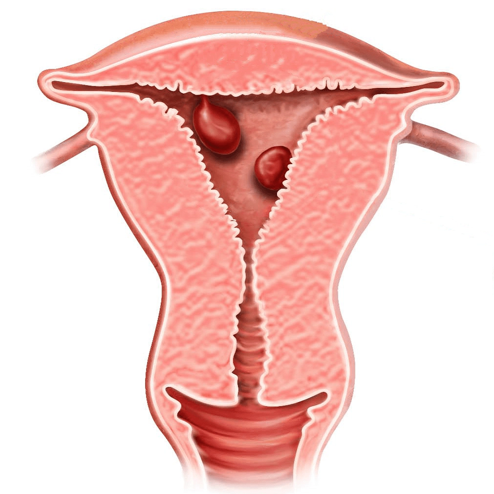 Polyp nội mạc tử cung: Các triệu chứng bạn nên biết