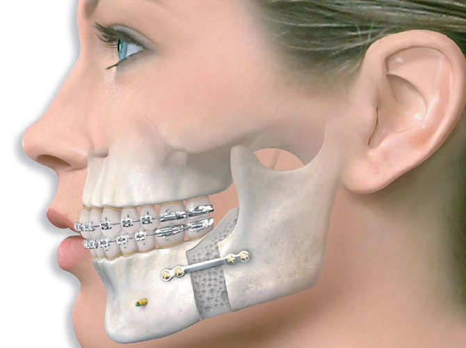 Quên bỏ đinh gãy xương mặt hàm trên 5 năm có tháo được không?