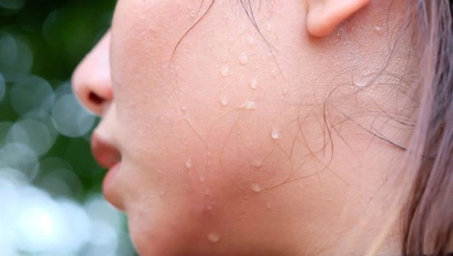 Ra nhiều mồ hôi ở mặt là bệnh gì?