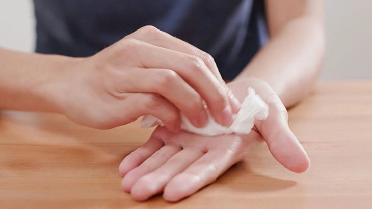 Ra nhiều mồ hôi tay chân điều trị thế nào?