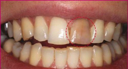 Răng chết tủy đổi màu có làm sáng được không?