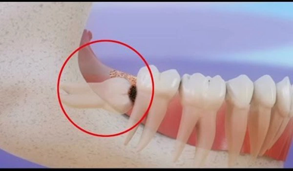 Răng khôn bị sâu có trám được không hay nên nhổ?