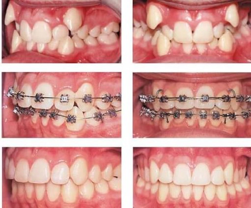 Răng "chạy" về vị trí cũ sau niềng, vì sao?