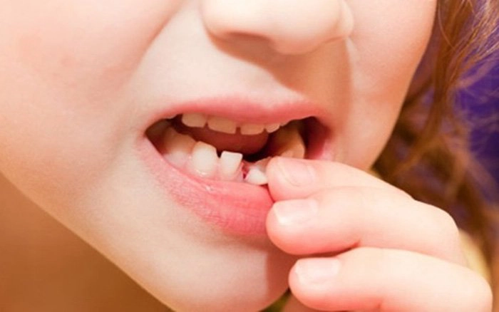 Răng sữa lung lay bao lâu thì nhổ?