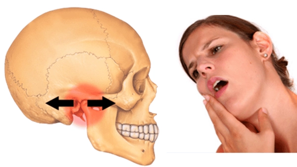 Rối loạn khớp thái dương hàm ảnh hưởng thế nào tới chất lượng sống?