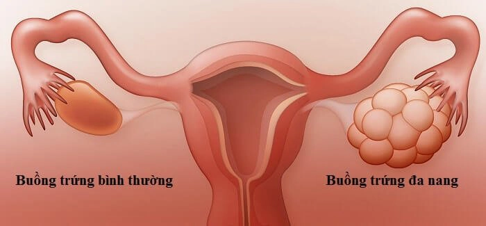 Rối loạn nội tiết trong hội chứng buồng trứng đa nang