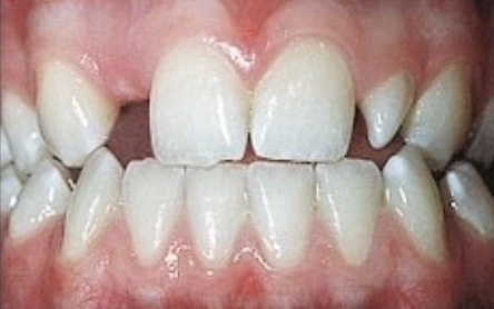 Rối loạn tạo răng có nguy hiểm?