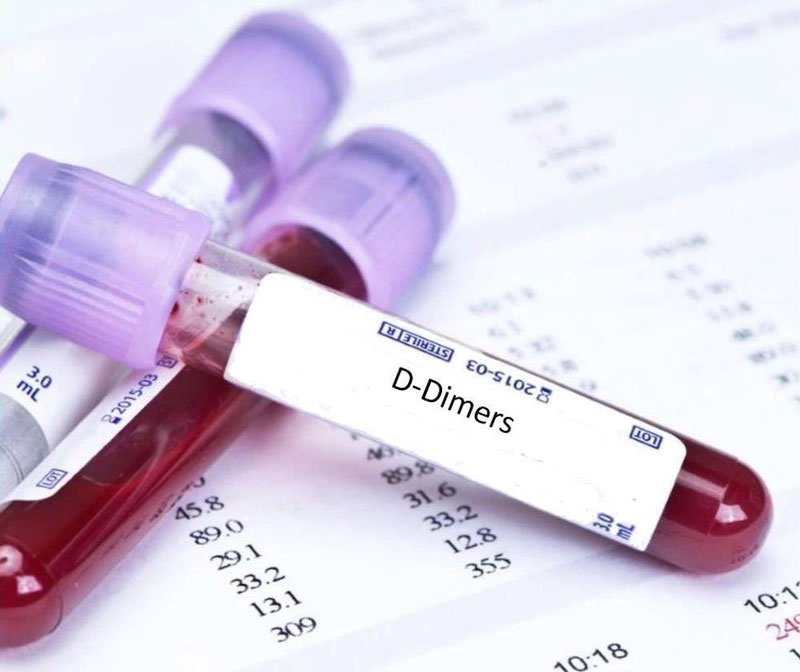 Sản phụ xét nghiệm D-dimer có chỉ số 7387 sau khỏi Covid có sao không?