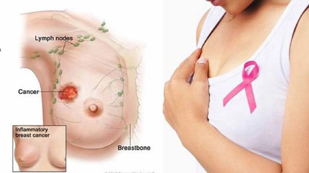 Sau áp xe tuyến sữa có bị mất sữa? Có cho con bú tiếp được không?