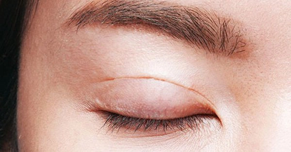 Sau khi cắt chỉ mí mắt có bôi thuốc mỡ không?