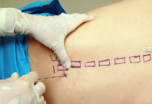Sau khi gây tê tủy sống mổ thoát vị bẹn có bị đau lưng không?