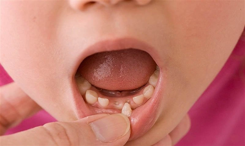 Sau khi nhổ răng sữa nên làm gì?