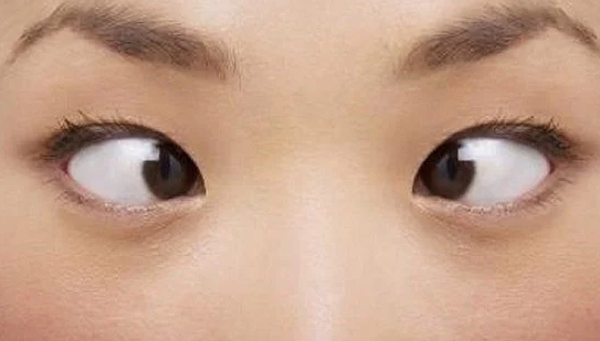Sau mổ đục thủy tinh thể bao lâu có thể chỉnh lé?